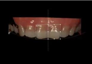 四环素牙的临床表现、诊断及治疗