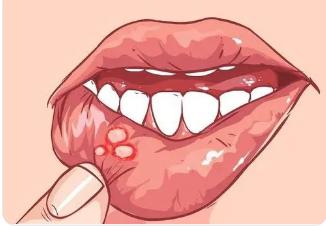 复发性口腔溃疡的病因、临床表现及治疗