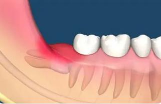 表现为牙龈肿大的病损应注意哪些疾病鉴别